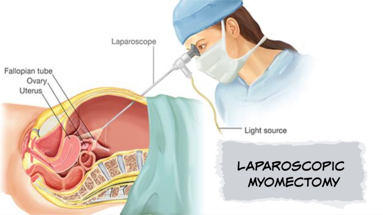 Laparoscopic Myomectomy