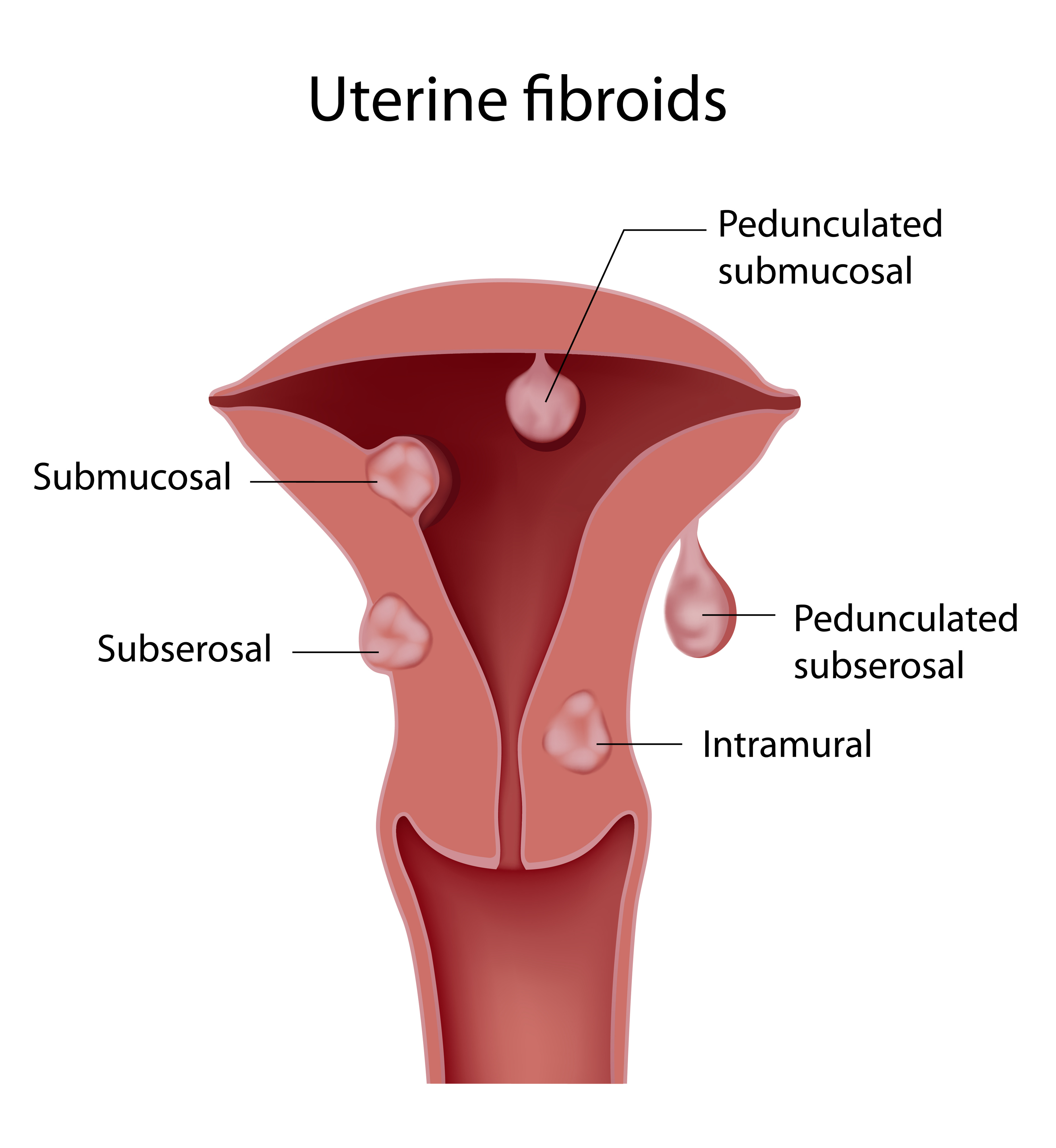 What is the recovery process after ectopic pregnancy treatment?, by Dr  Neha Lalla