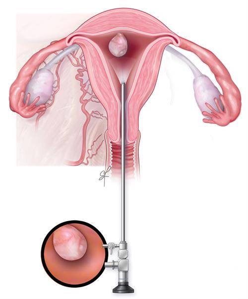 Hysteroscopic Myoma Resection Specialist in Dubai