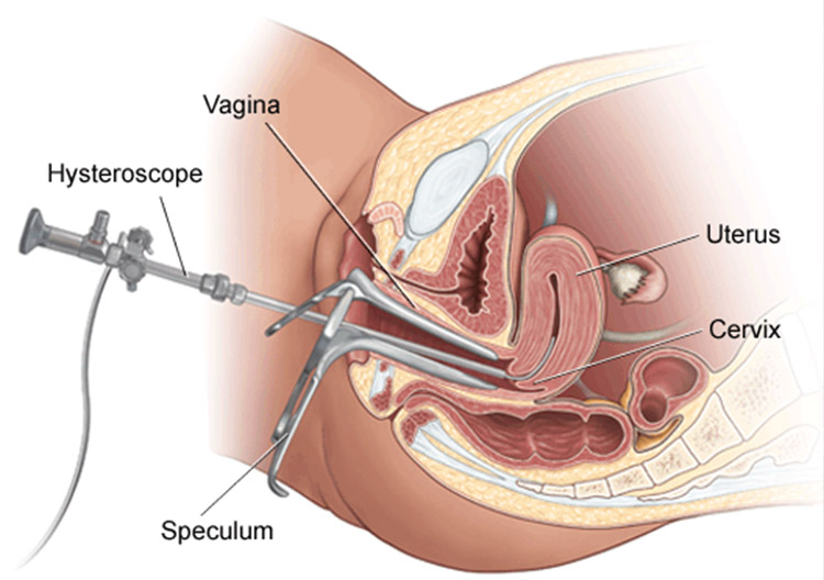 hysteroscopy operation 