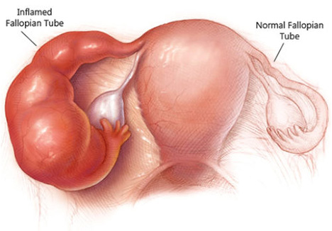 Hydrosalpinx treatment in thane