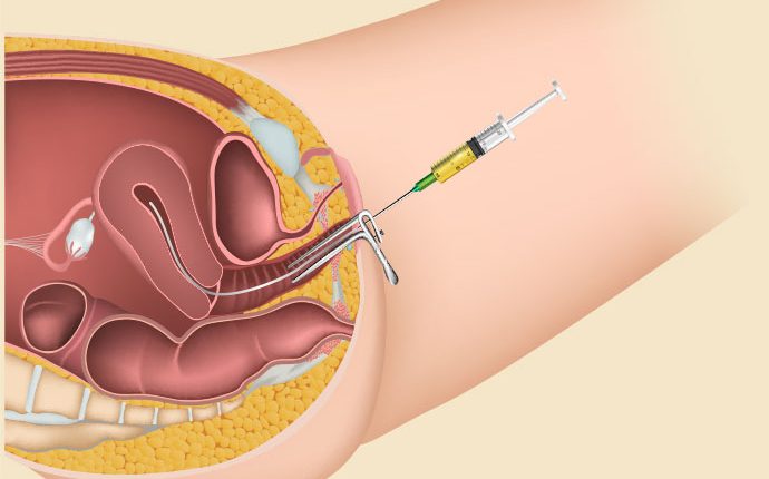 IUI Treatment Procedure for Infertility in Thane