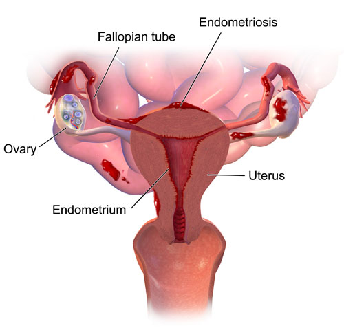 Endometriosis treatment in thane