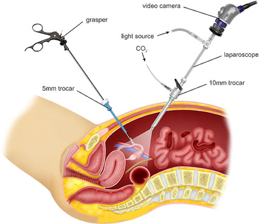 Total Laparoscopic Hysterectomy