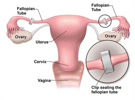 Family planning treatment