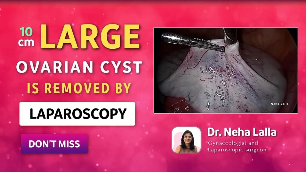 Ovarian Cyst Signs and Symptoms