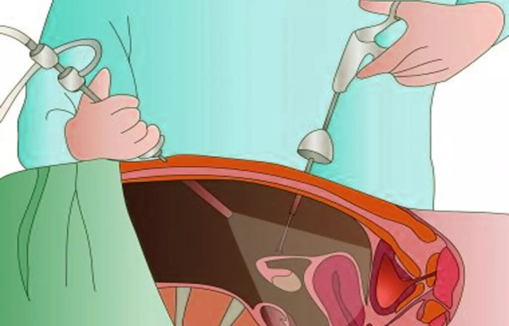 Fibroid Treatment in Dubai