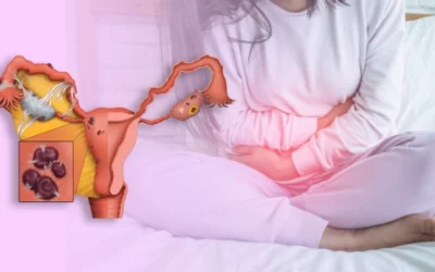 Endometriosis | When should you consider surgery?