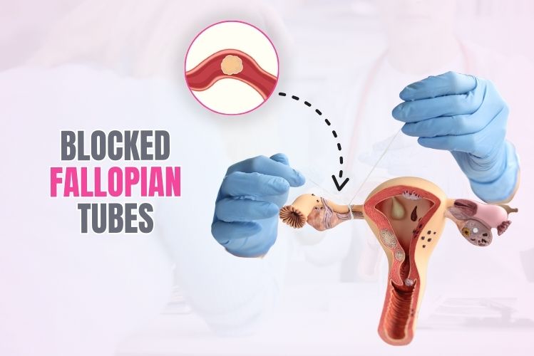 blocked Fallopian tubes