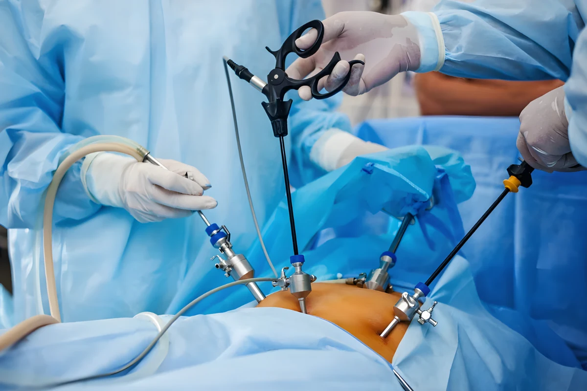 Laparoscopic Surgery: Is It the Best Option for Fibroid Removal?